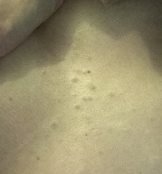 Under skin spots