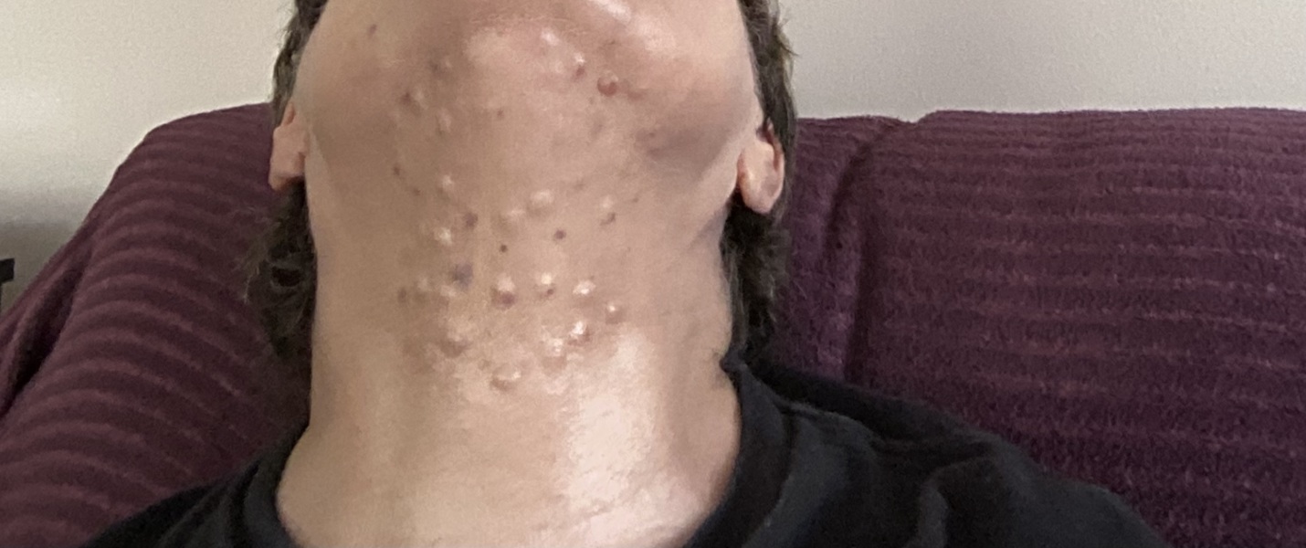 Microneedling