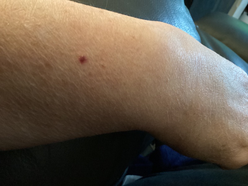 Skin spot - Has anyone had anything that looks like this?