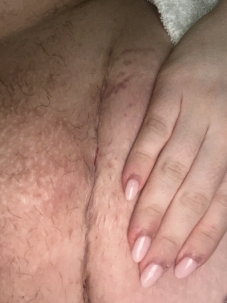 C section incision slightly split ??