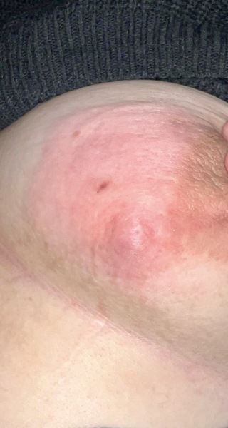 To ask if breast abscess is an emergency or can wait?