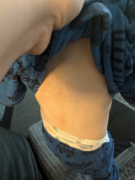 Blotchy rash on toddler.