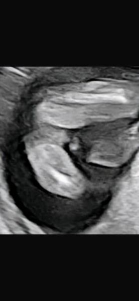 Gender at 16+ weeks