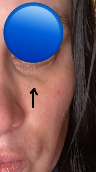 To think my under eye filler looks awful?