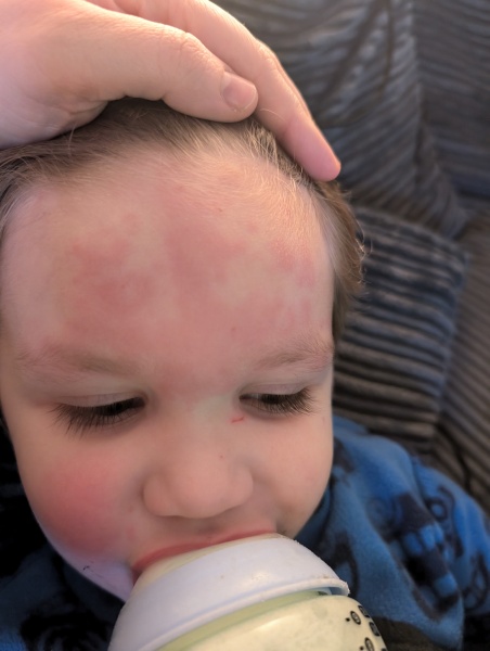 Blotchy rash on toddler.