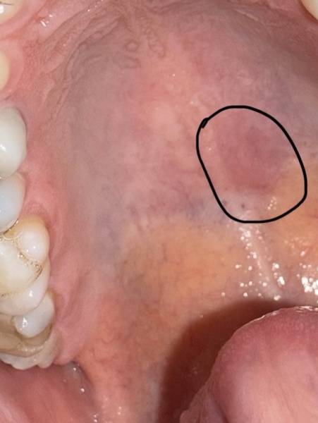 Painful bump on roof of mouth