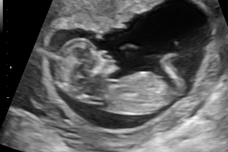Boy or Girl from Scan??