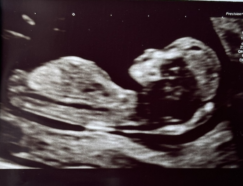 Any nub theorists out there? Boy or girl