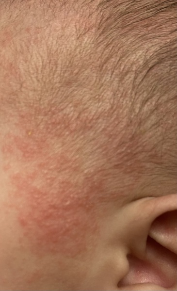 Rash on baby face