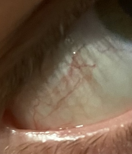 What’s wrong with my eye? (With photo)