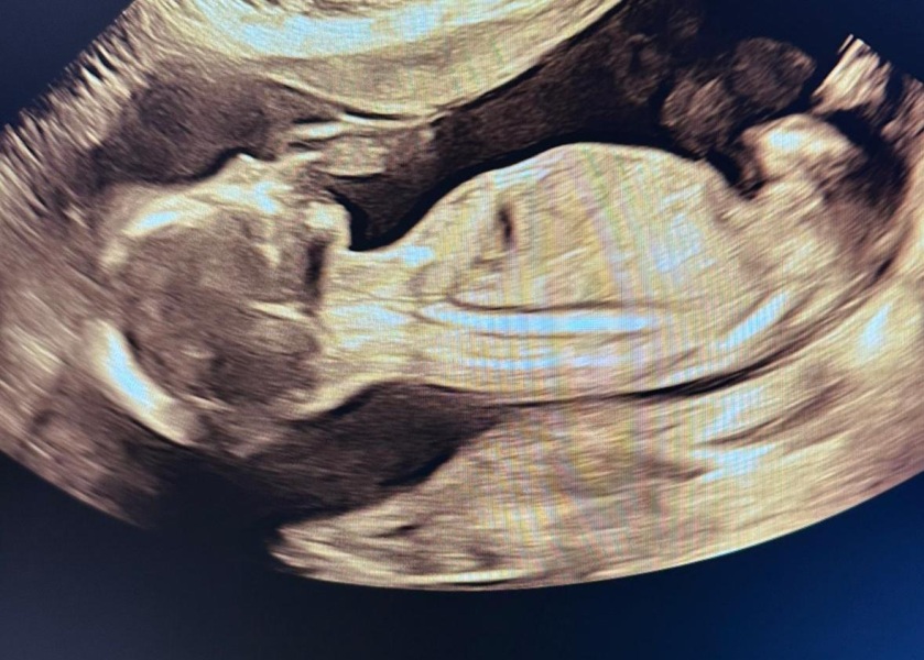 20w Scan - boy or girl?