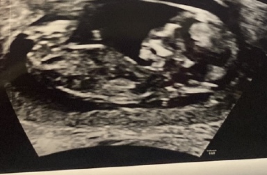Due July 25 - Thread 2 - Approaching the 12 week scans!