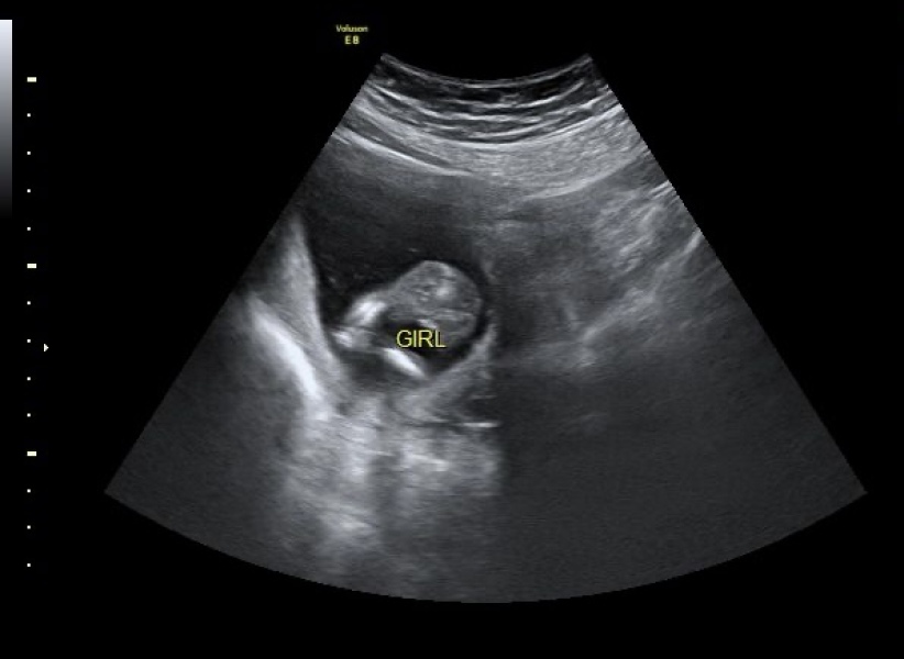 15w 2d Gender scan