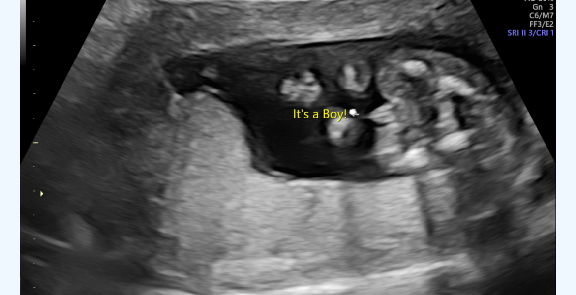 Potty shot - boy or girl??