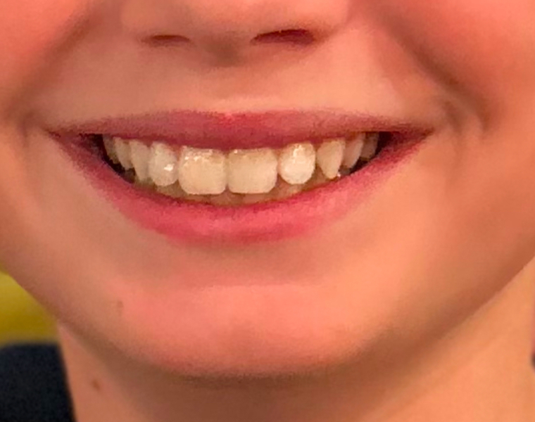 Knocked out tooth at 3.5