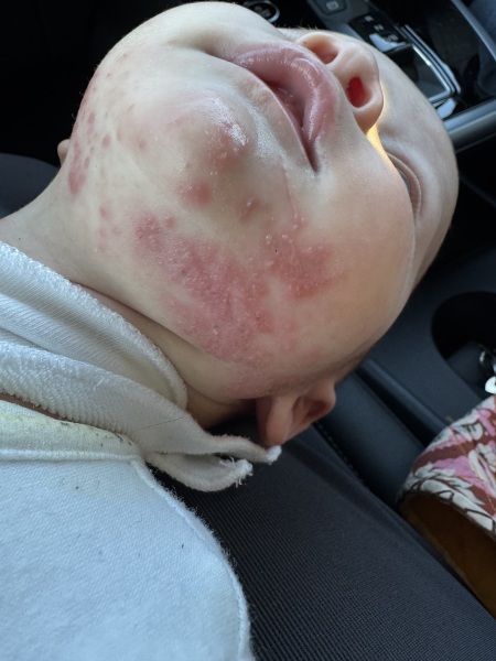 allergy or other rash?