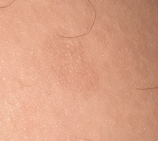 Ringworm  ?