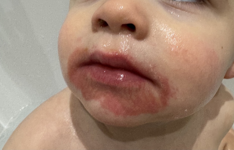 PLEASE HELP - Sore skin around 17mo’s mouth