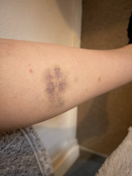 Bruising on leg
