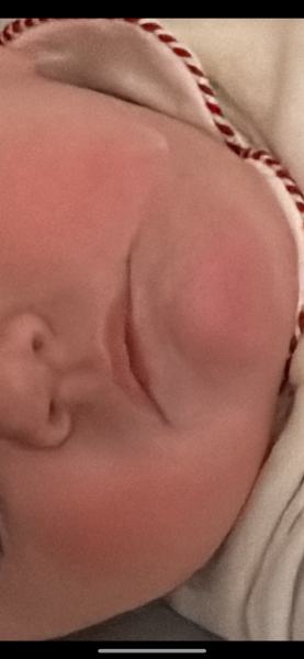Fifth disease or teething cheeks etc?