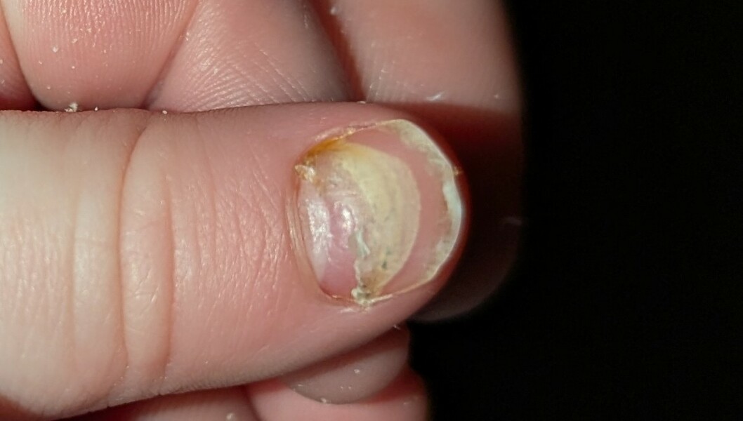 Nail cracked off at cuticle
