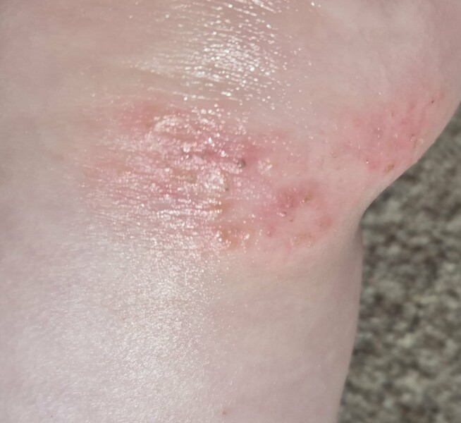 Can anyone help figure out my child's skin condition?