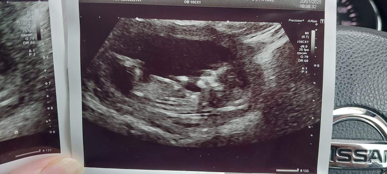 Nub theory guesses, boy or girl?