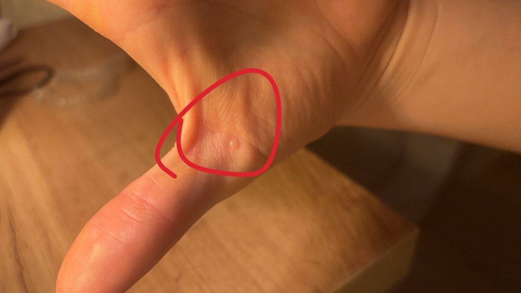 Tiny lump on thumb