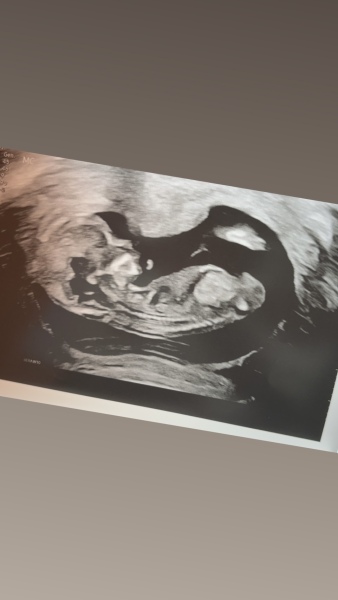 What’s this on my scan?