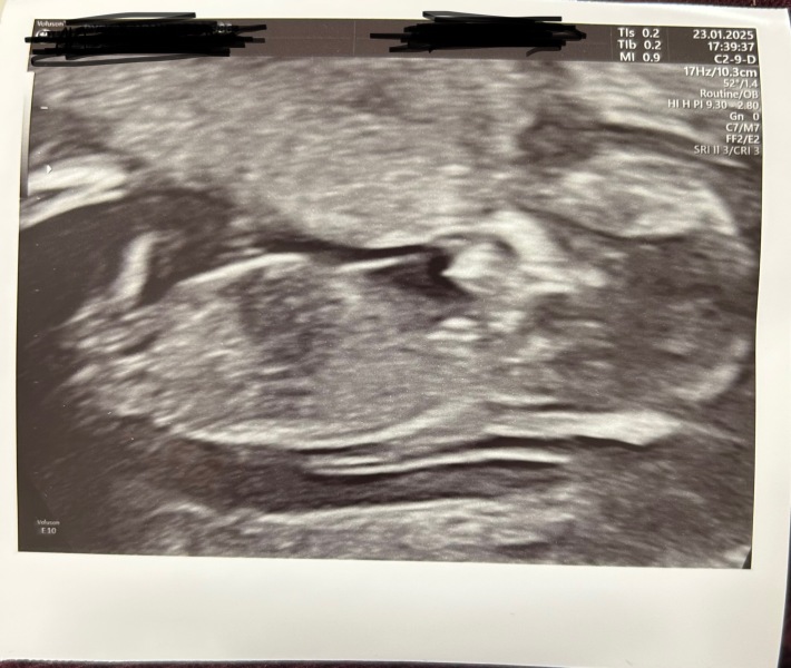 Scan tomorrow and possibly starting a cold?