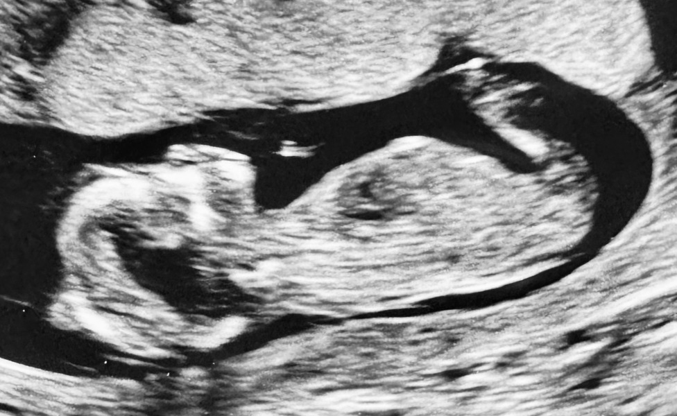 12 Week Scan Nerves