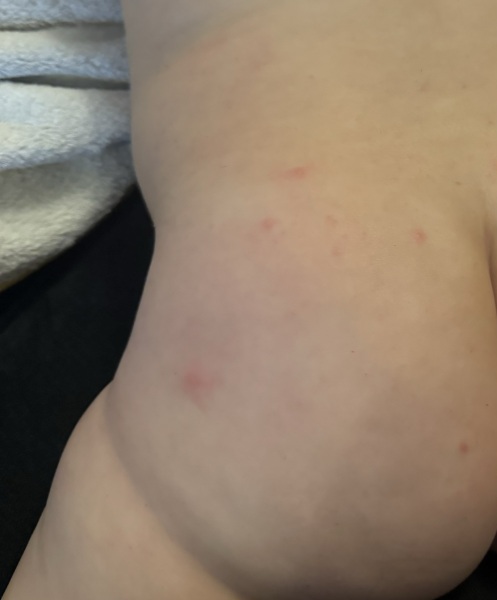 7.5month baby rash