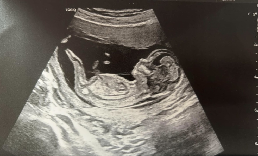 Skull theory - recurrent miscarriage