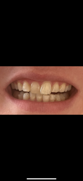 Not sure if I’m happy with Invisalign results…