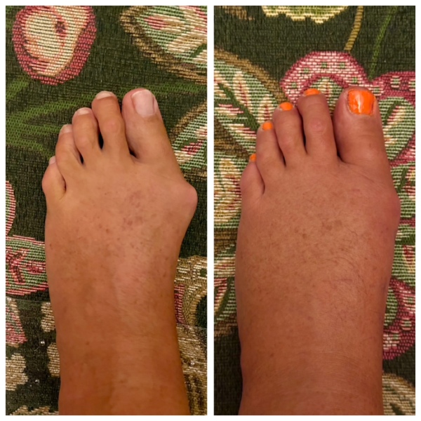 Bunion Keyhole surgery