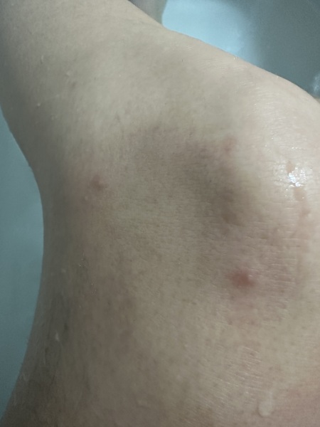 Help- do I have chicken pox??