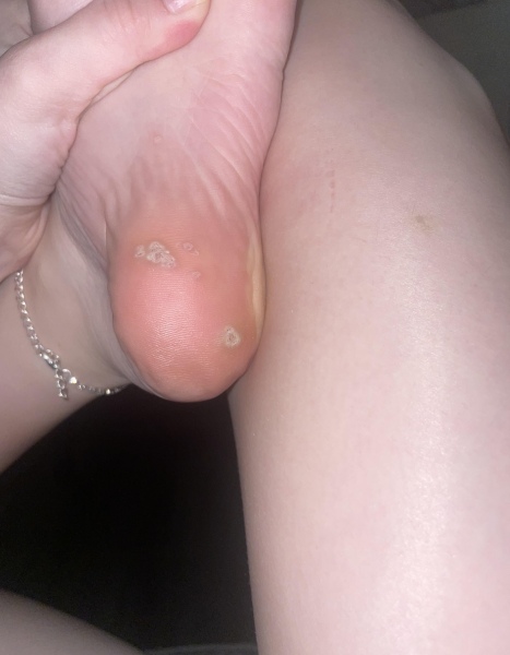 Anyone ever had verrucas?