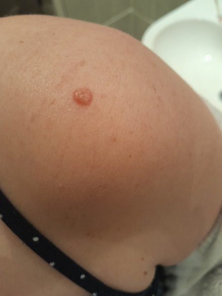 Mole worry