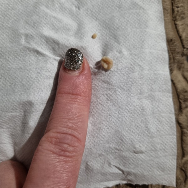 Epic Tonsil stone