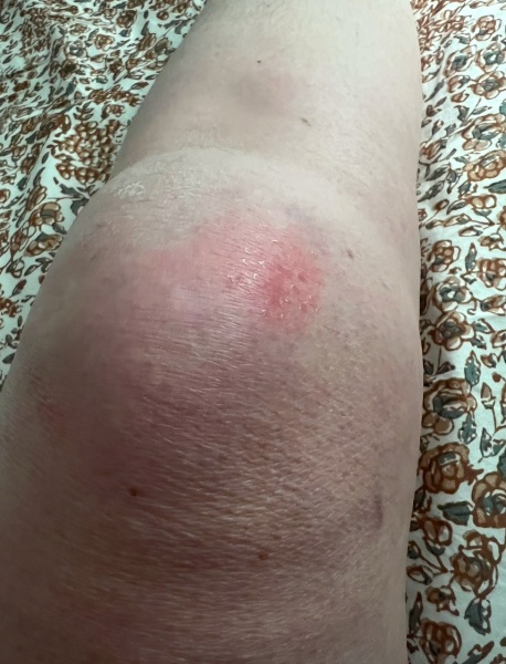 Accident on dodgy path