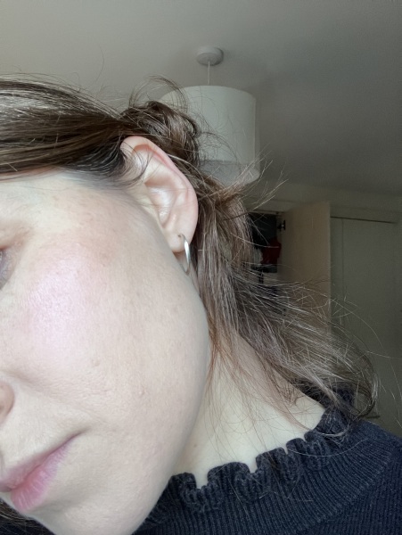 What to do to improve skin/light acne scarring/hyoerpigmentation?