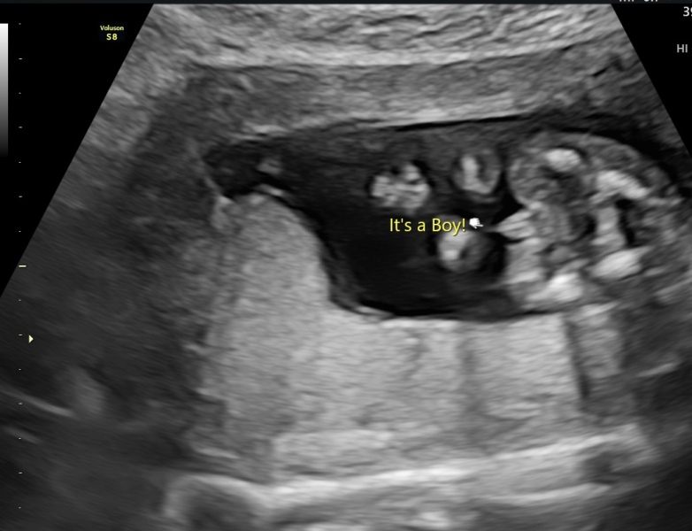 Early scan - wrong gender??