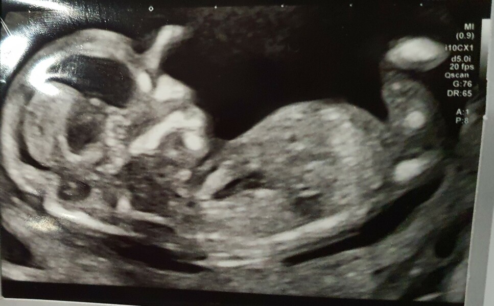 Nub theory guesses 13 week +1