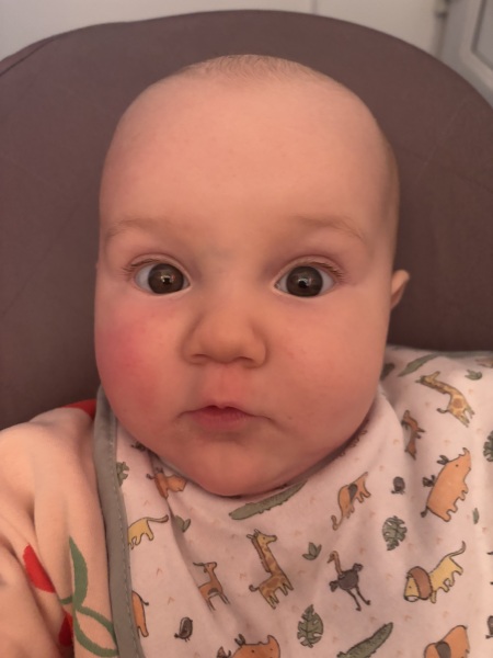 Baby’s nose bridge bruise