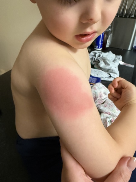 Post Vaccination redness?