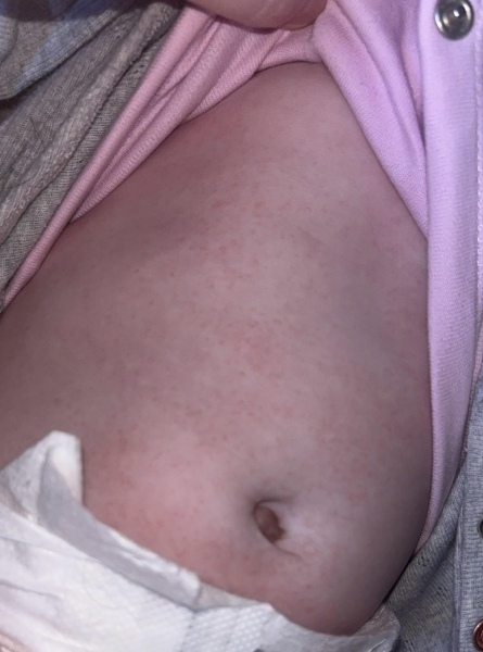 Rash on abdomen