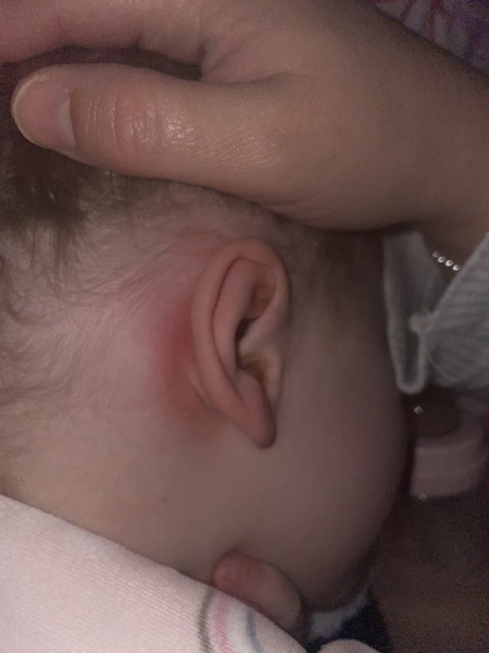 Rash and red behind ear -pox? Mastoiditis ?