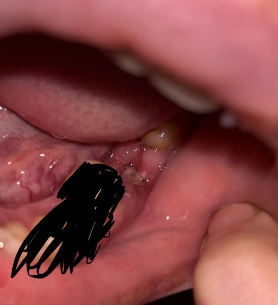 HELP! Dry socket??