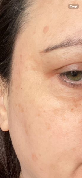 Monderma prescription for pigmentation