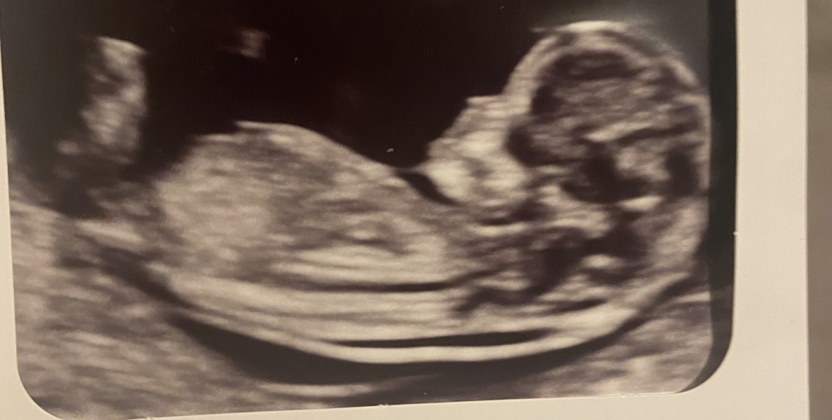 Boy or Girl?